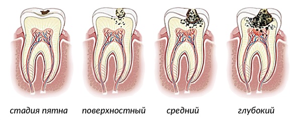 Стадии развития кариеса