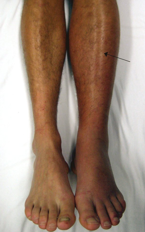 Как проявляется тромбоз глубоких вен на ногах