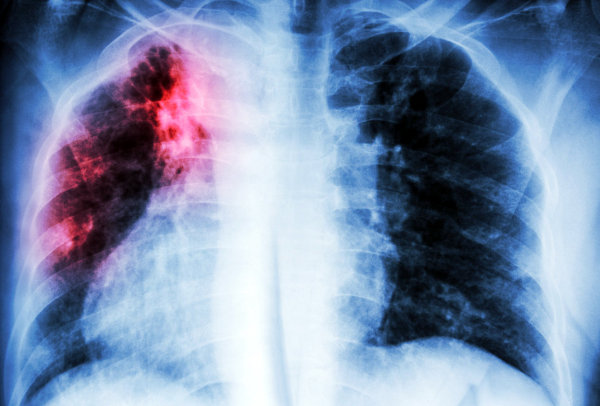Рентген лёгких при туберкулёзе