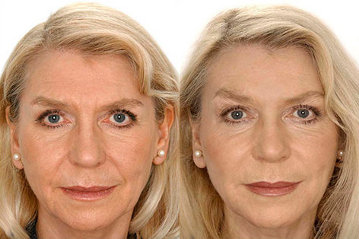 Гиалуроновая кислота в любом возрасте может улучшить внешний вид