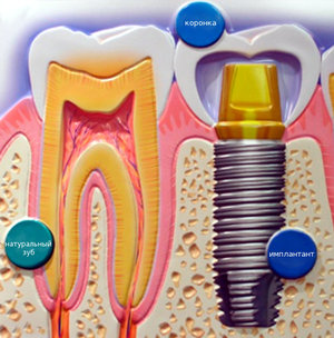 Имплантация зубов