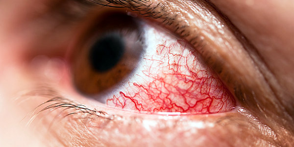 Красные глаза. Сетка кровеносных сосудов