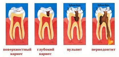 Схемы заболеваний зубов