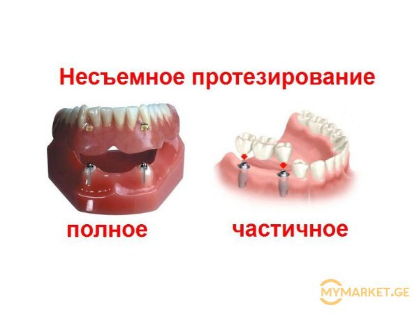 Типы несъемных протезов зубов